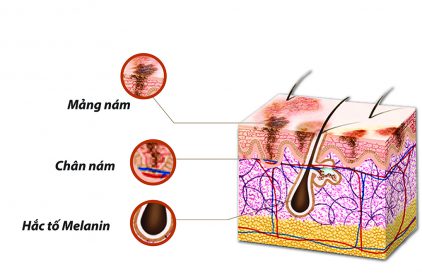 Spa nào trị nám hiệu quả, an toàn tại Biên Hòa?