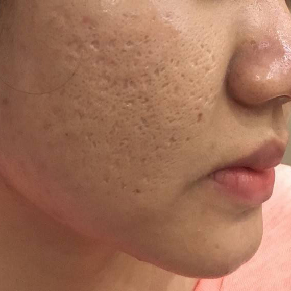 Điều trị sẹo rỗ